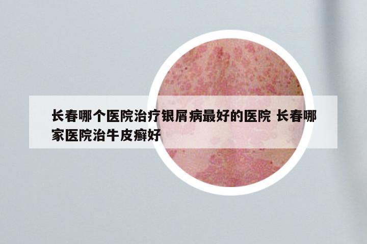 长春哪个医院治疗银屑病最好的医院 长春哪家医院治牛皮癣好