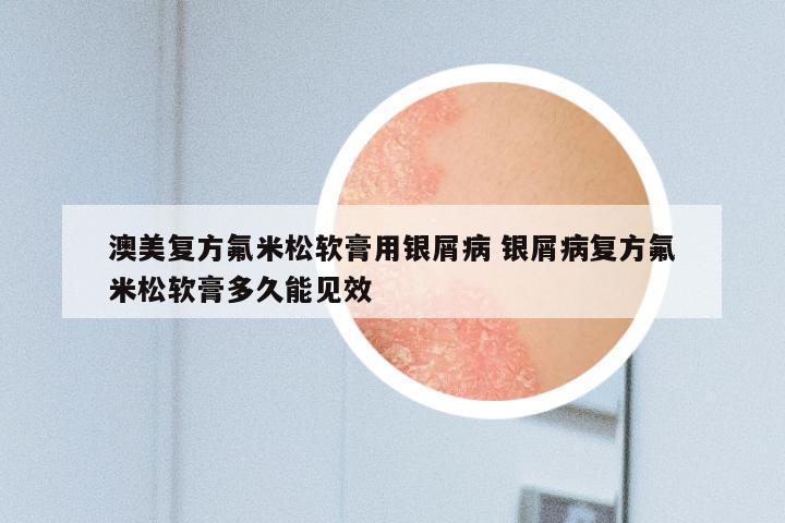 澳美复方氟米松软膏用银屑病 银屑病复方氟米松软膏多久能见效