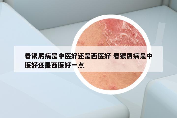看银屑病是中医好还是西医好 看银屑病是中医好还是西医好一点
