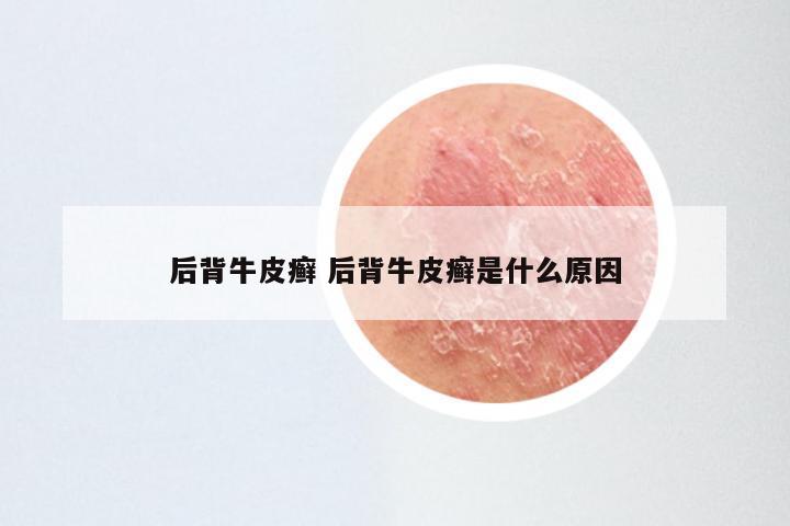 后背牛皮癣 后背牛皮癣是什么原因