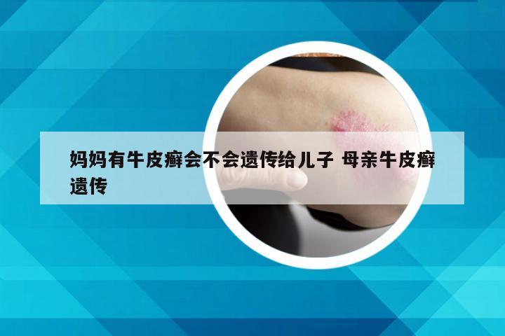 妈妈有牛皮癣会不会遗传给儿子 母亲牛皮癣遗传