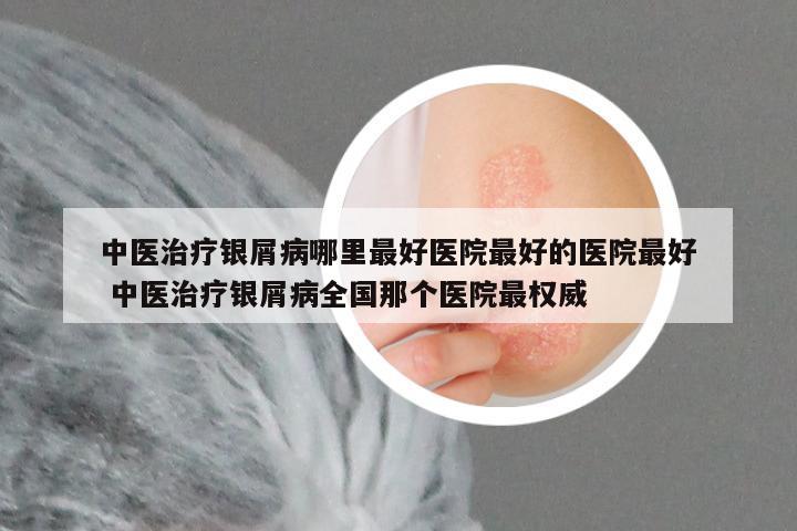 中医治疗银屑病哪里最好医院最好的医院最好 中医治疗银屑病全国那个医院最权威