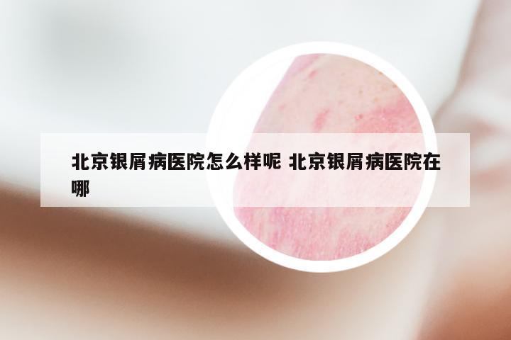 北京银屑病医院怎么样呢 北京银屑病医院在哪