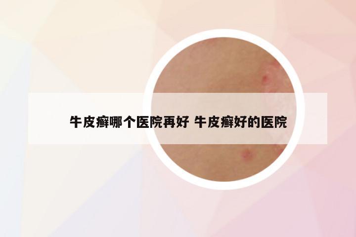 牛皮癣哪个医院再好 牛皮癣好的医院