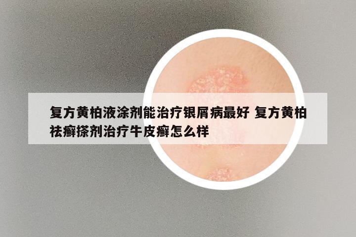 复方黄柏液涂剂能治疗银屑病最好 复方黄柏祛癣搽剂治疗牛皮癣怎么样