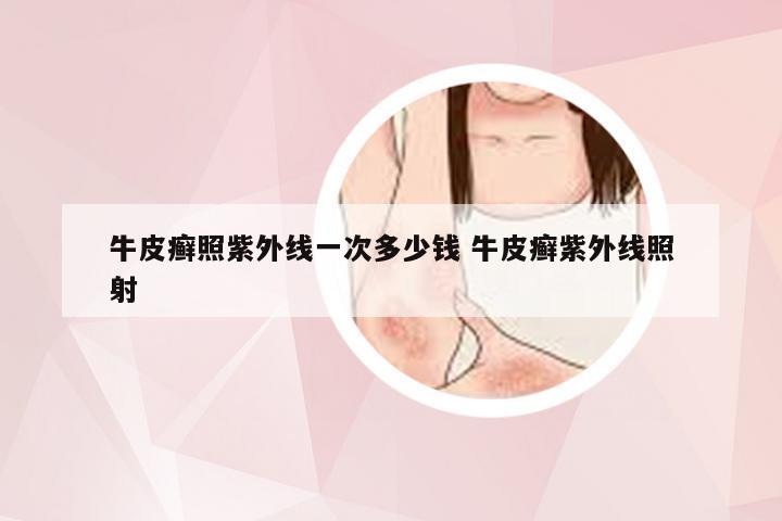 牛皮癣照紫外线一次多少钱 牛皮癣紫外线照射