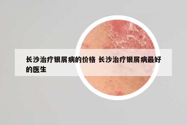 长沙治疗银屑病的价格 长沙治疗银屑病最好的医生