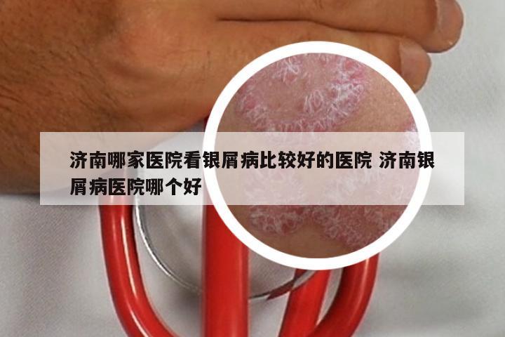 济南哪家医院看银屑病比较好的医院 济南银屑病医院哪个好