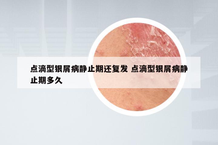 点滴型银屑病静止期还复发 点滴型银屑病静止期多久