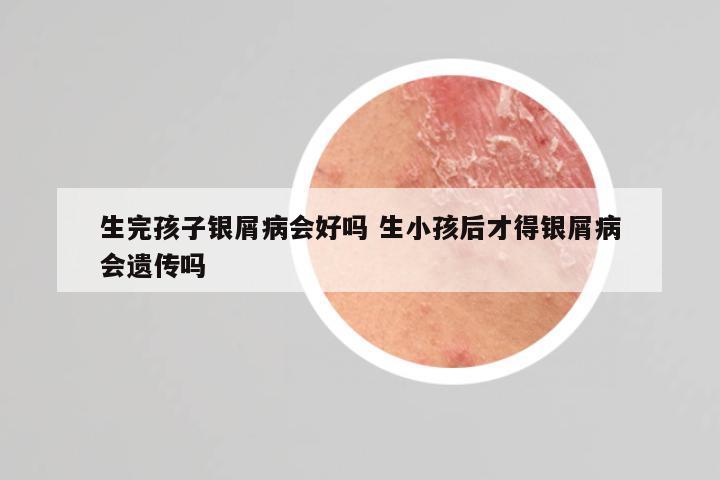 生完孩子银屑病会好吗 生小孩后才得银屑病会遗传吗