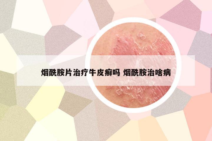 烟酰胺片治疗牛皮癣吗 烟酰胺治啥病