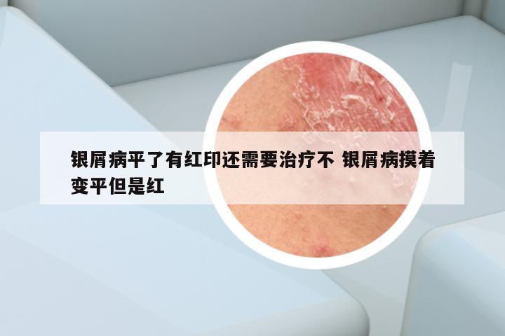 银屑病平了有红印还需要治疗不 银屑病摸着变平但是红