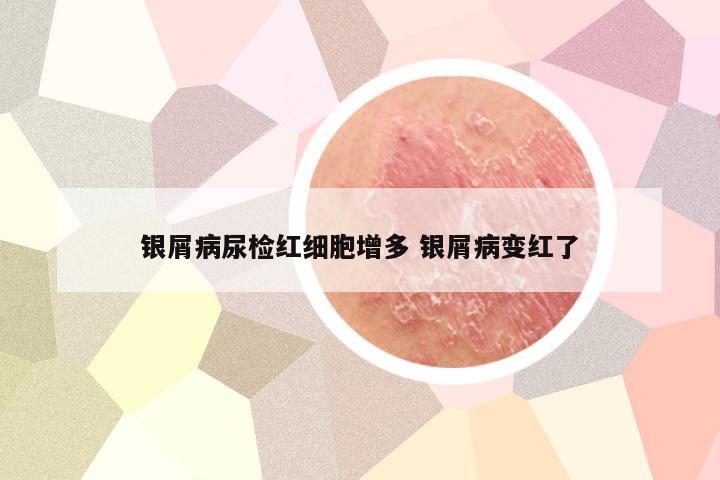 银屑病尿检红细胞增多 银屑病变红了