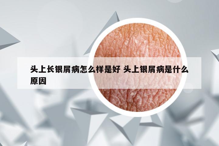 头上长银屑病怎么样是好 头上银屑病是什么原因