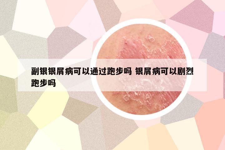 副银银屑病可以通过跑步吗 银屑病可以剧烈跑步吗