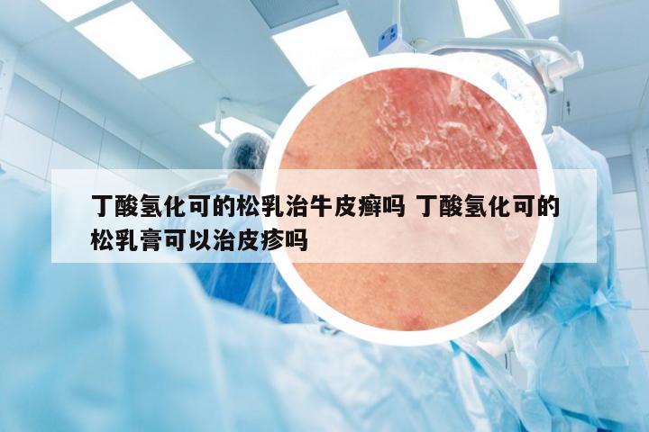 丁酸氢化可的松乳治牛皮癣吗 丁酸氢化可的松乳膏可以治皮疹吗