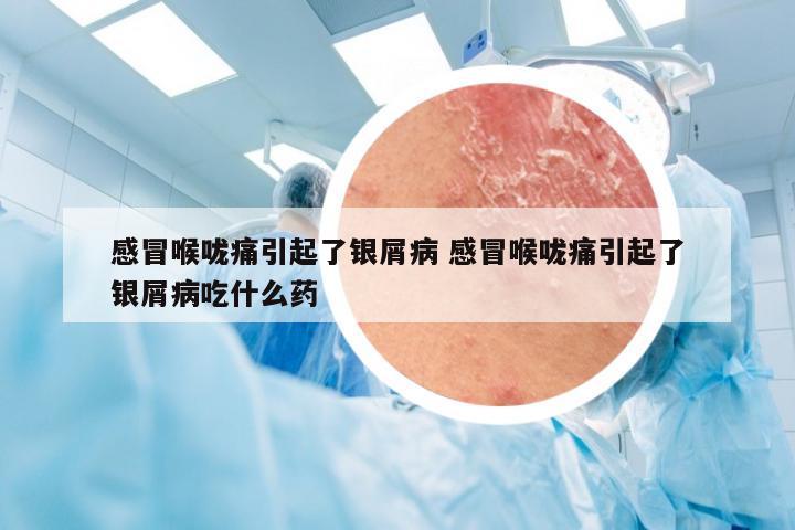 感冒喉咙痛引起了银屑病 感冒喉咙痛引起了银屑病吃什么药