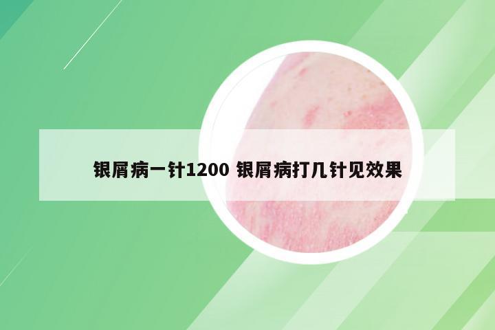 银屑病一针1200 银屑病打几针见效果