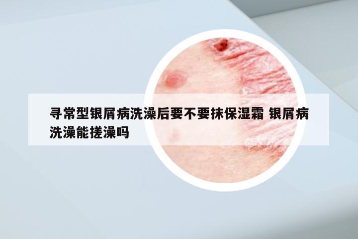 寻常型银屑病洗澡后要不要抹保湿霜 银屑病洗澡能搓澡吗