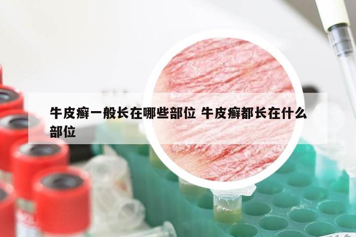 牛皮癣一般长在哪些部位 牛皮癣都长在什么部位