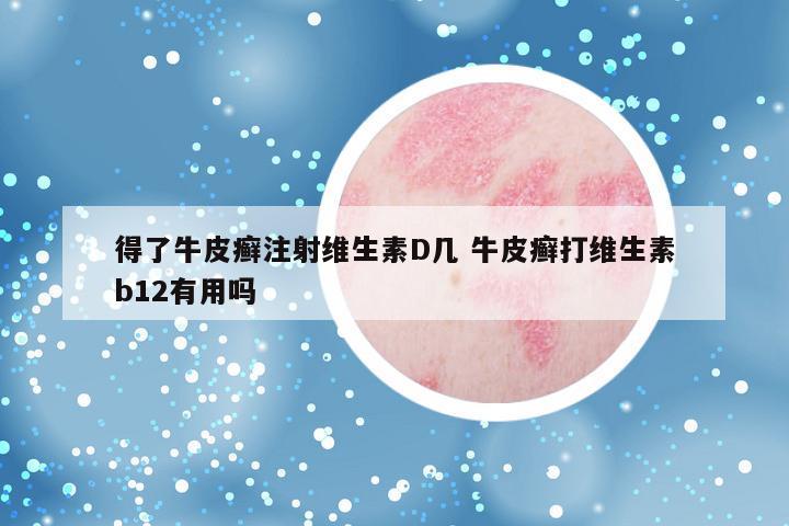得了牛皮癣注射维生素D几 牛皮癣打维生素b12有用吗