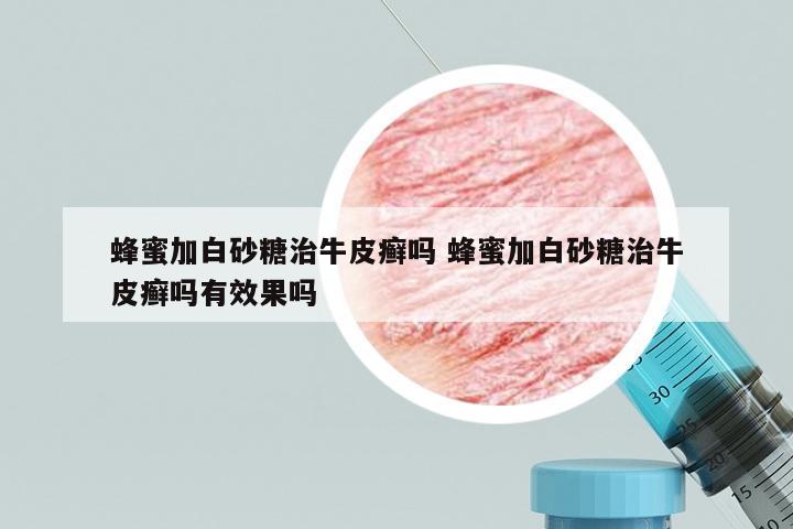 蜂蜜加白砂糖治牛皮癣吗 蜂蜜加白砂糖治牛皮癣吗有效果吗