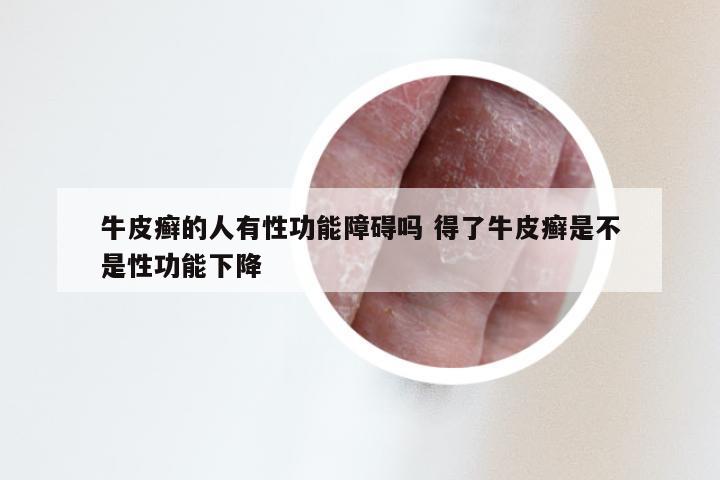 牛皮癣的人有性功能障碍吗 得了牛皮癣是不是性功能下降