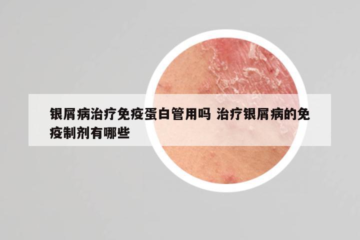 银屑病治疗免疫蛋白管用吗 治疗银屑病的免疫制剂有哪些