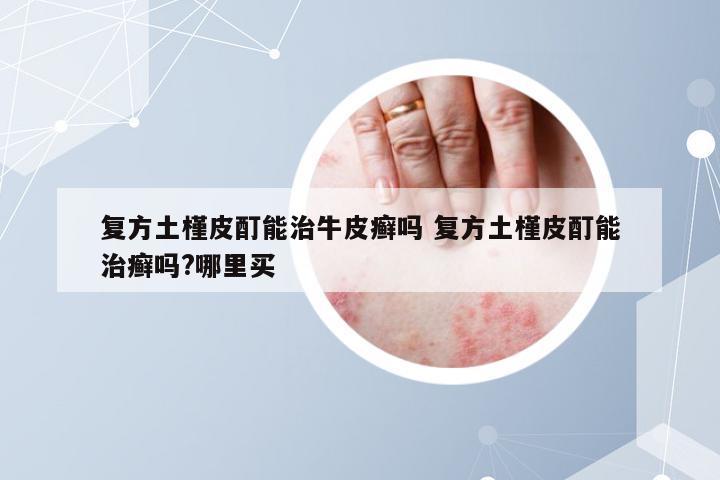 复方土槿皮酊能治牛皮癣吗 复方土槿皮酊能治癣吗?哪里买