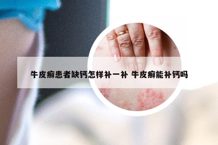 牛皮癣患者缺钙怎样补一补 牛皮癣能补钙吗