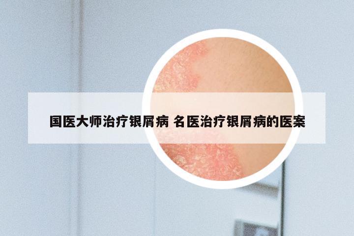国医大师治疗银屑病 名医治疗银屑病的医案