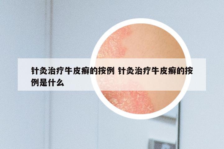 针灸治疗牛皮癣的按例 针灸治疗牛皮癣的按例是什么