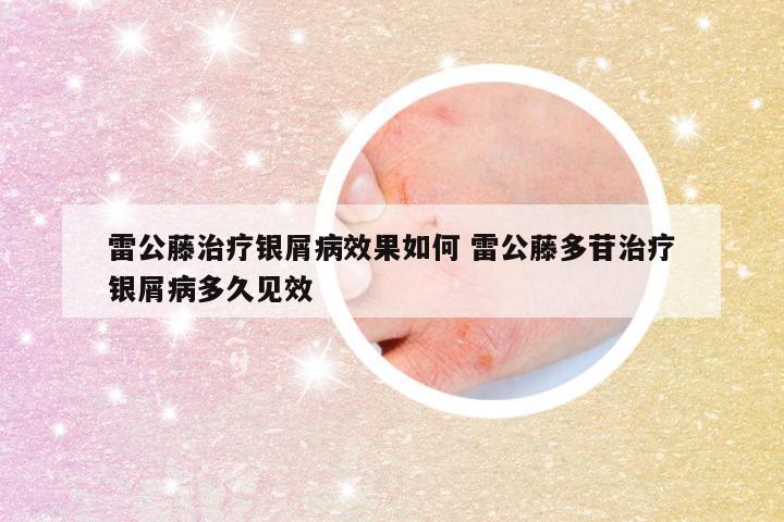 雷公藤治疗银屑病效果如何 雷公藤多苷治疗银屑病多久见效