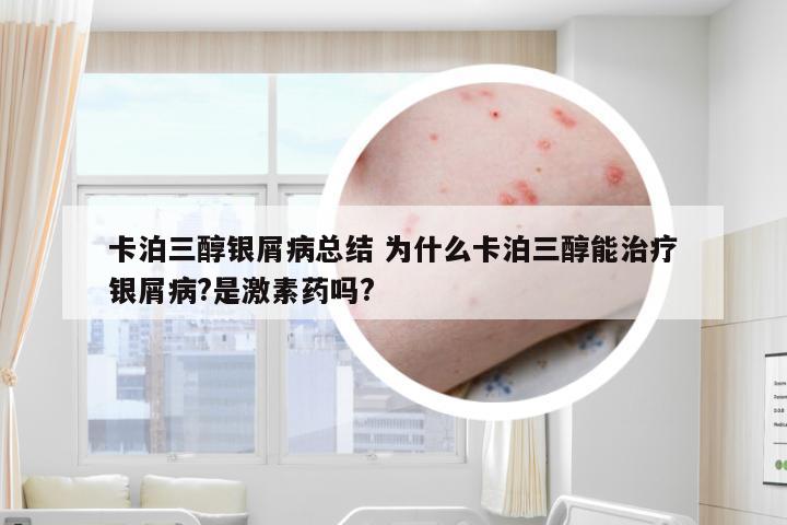 卡泊三醇银屑病总结 为什么卡泊三醇能治疗银屑病?是激素药吗?