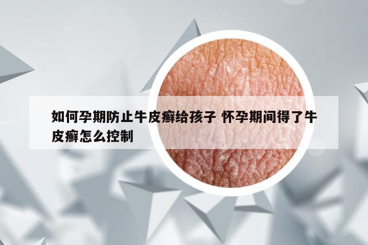 如何孕期防止牛皮癣给孩子 怀孕期间得了牛皮癣怎么控制