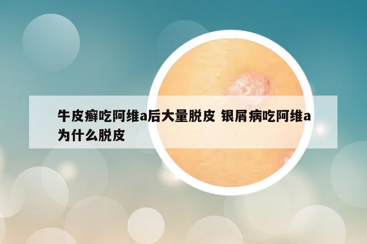 牛皮癣吃阿维a后大量脱皮 银屑病吃阿维a为什么脱皮