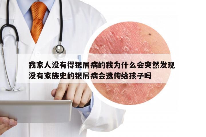 我家人没有得银屑病的我为什么会突然发现 没有家族史的银屑病会遗传给孩子吗