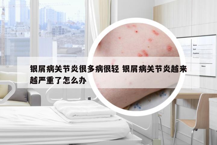 银屑病关节炎很多病很轻 银屑病关节炎越来越严重了怎么办