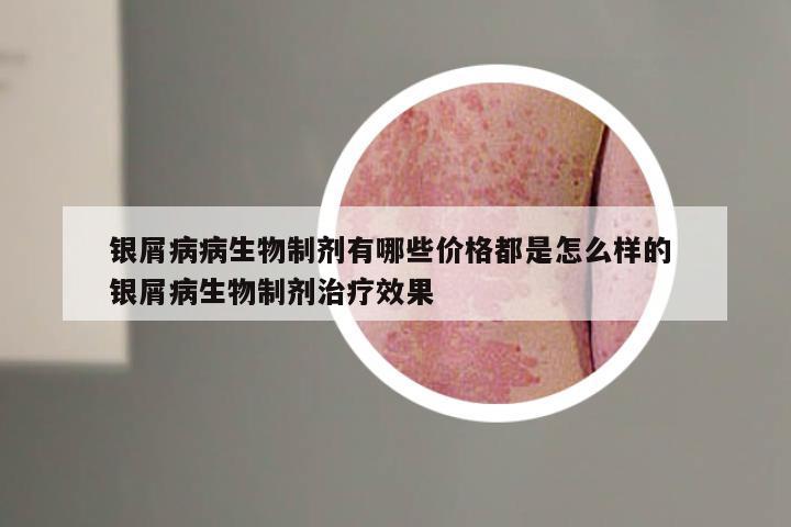银屑病病生物制剂有哪些价格都是怎么样的 银屑病生物制剂治疗效果