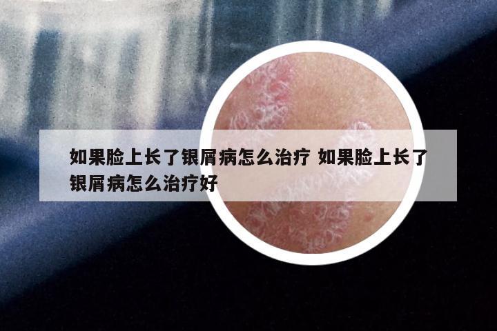 如果脸上长了银屑病怎么治疗 如果脸上长了银屑病怎么治疗好