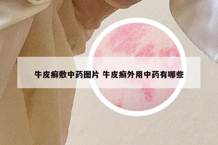 牛皮癣敷中药图片 牛皮癣外用中药有哪些