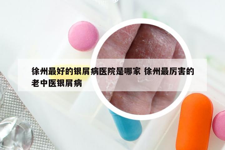 徐州最好的银屑病医院是哪家 徐州最厉害的老中医银屑病