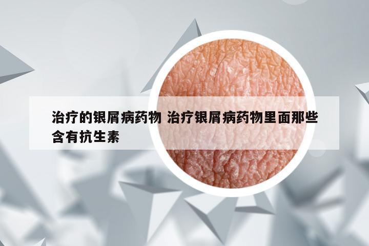 治疗的银屑病药物 治疗银屑病药物里面那些含有抗生素