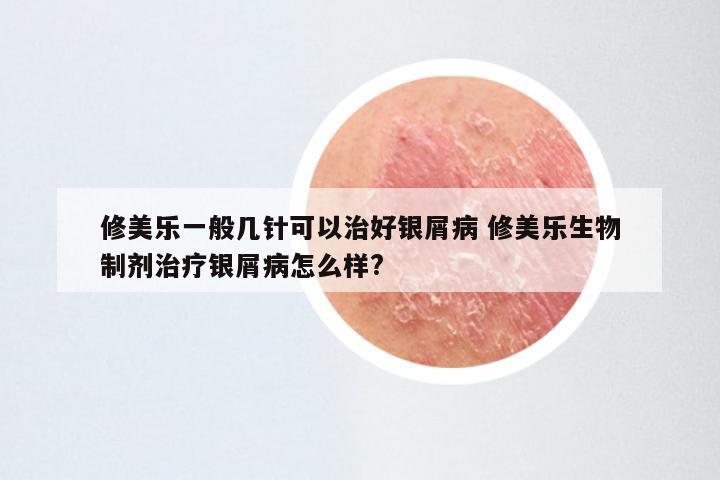 修美乐一般几针可以治好银屑病 修美乐生物制剂治疗银屑病怎么样?