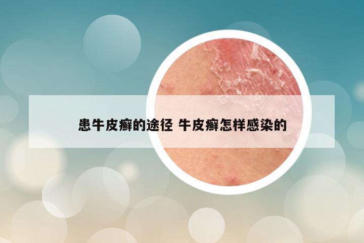 患牛皮癣的途径 牛皮癣怎样感染的