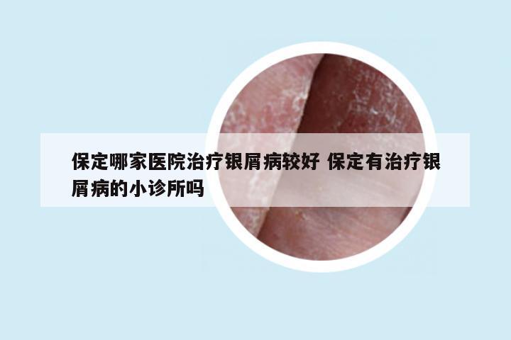 保定哪家医院治疗银屑病较好 保定有治疗银屑病的小诊所吗