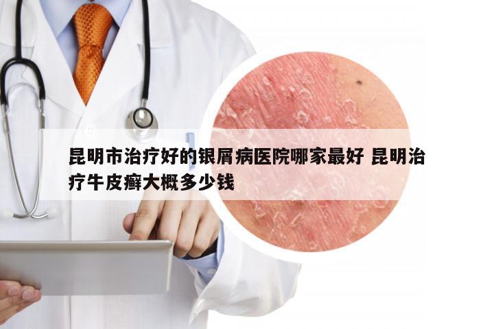 昆明市治疗好的银屑病医院哪家最好 昆明治疗牛皮癣大概多少钱