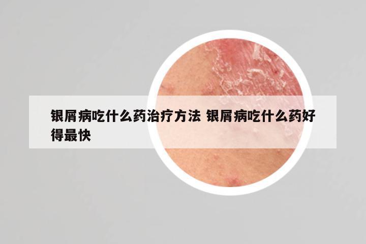 银屑病吃什么药治疗方法 银屑病吃什么药好得最快
