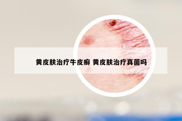黄皮肤治疗牛皮癣 黄皮肤治疗真菌吗