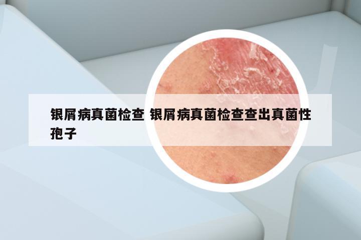 银屑病真菌检查 银屑病真菌检查查出真菌性孢子